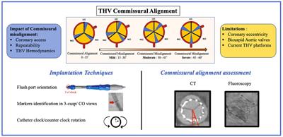 Transcatheter heart valve commissural alignment: an updated review